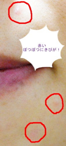 にきび